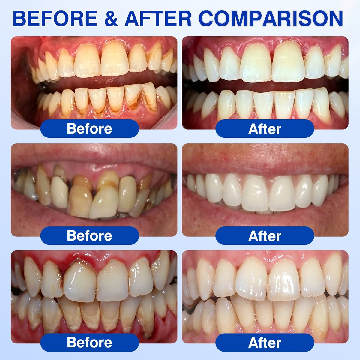 🔥LAST DAY 49% OFF - 🏅🦷🛡️Evolvion® GumRevive Periodontal Repair Gel