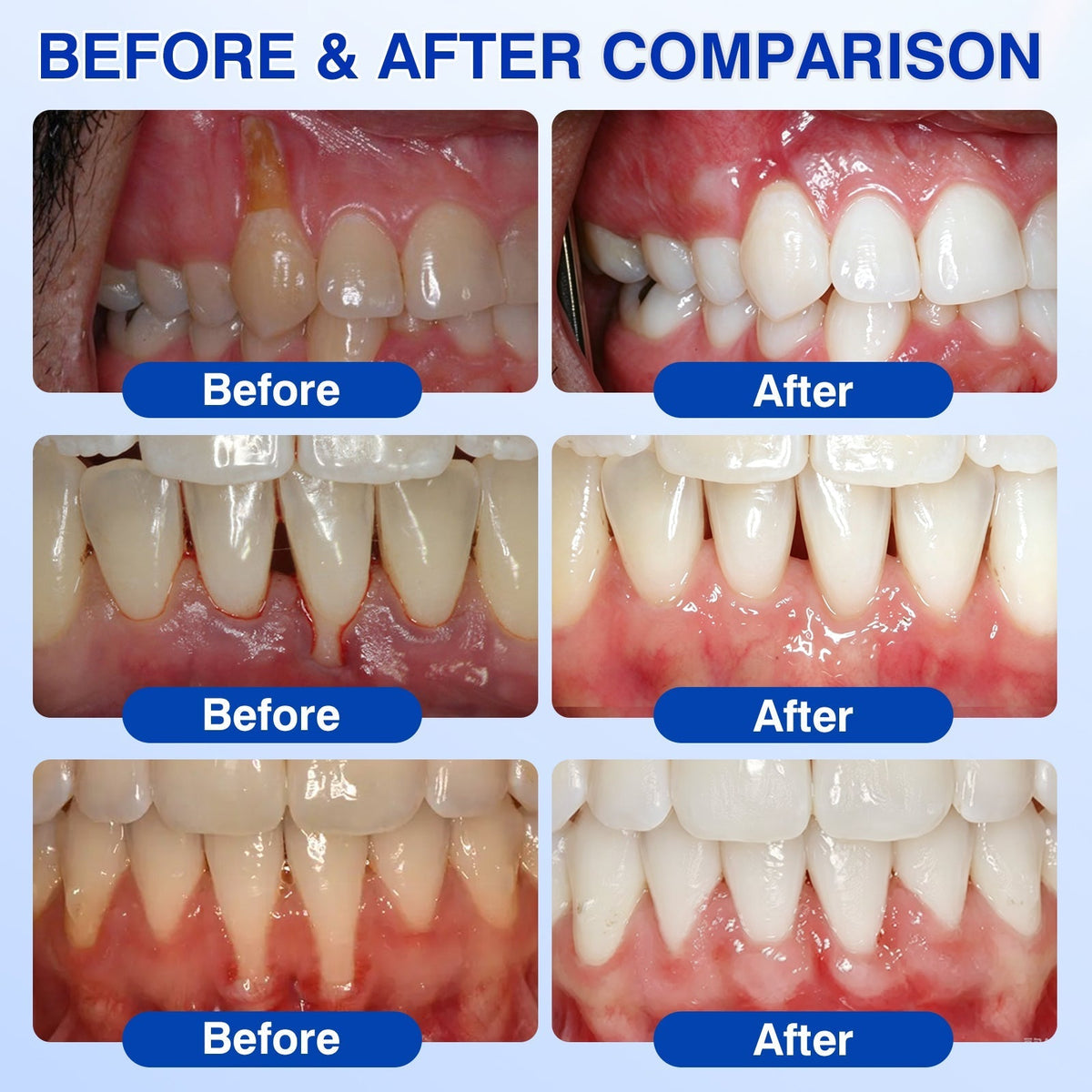🔥LAST DAY 49% OFF - 🏅🦷🛡️Evolvion® GumRevive Periodontal Repair Gel
