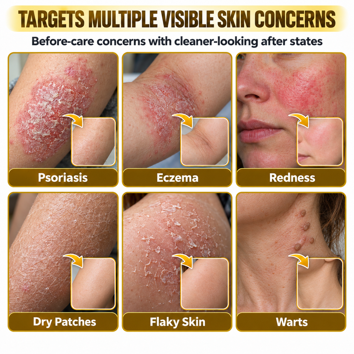 Timlk® PsoriaSoothe Bee Venom Skin-Restoration Cream