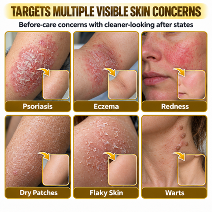 Timlk® PsoriaSoothe Bee Venom Skin-Restoration Cream