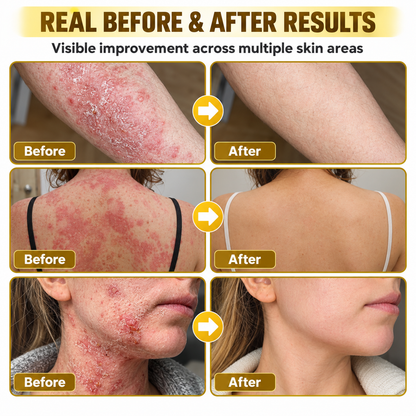 Timlk® PsoriaSoothe Bee Venom Skin-Restoration Cream